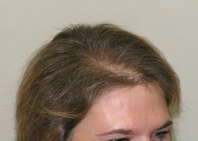 Female Hair Loss Photo 9