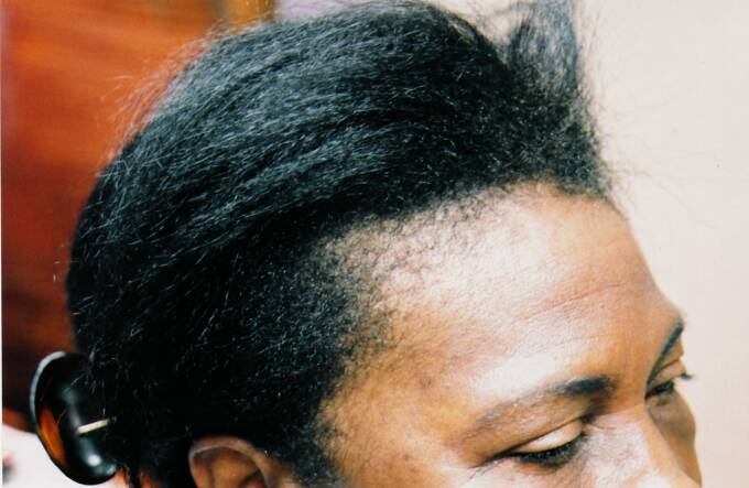 Female Hair Loss Photo 4