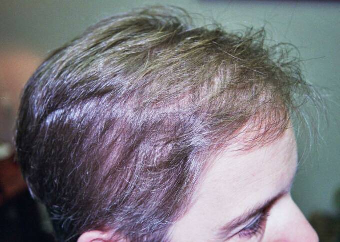 Female Hair Loss Photo 6