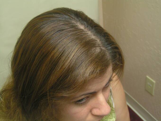 Female Hair Loss Photo 8