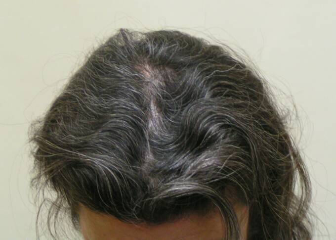 Female Hair Loss Photo 12