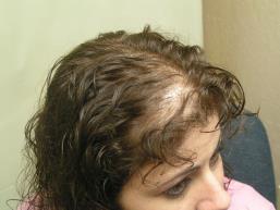 Female Hair Loss Photo 7